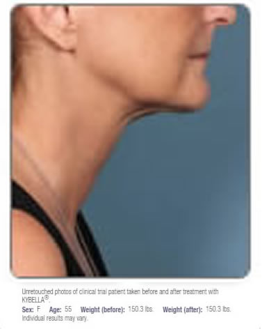 kybella results after long island great neck
